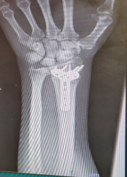 x-ray - workers comp injury - Legalmente Hablando Indy